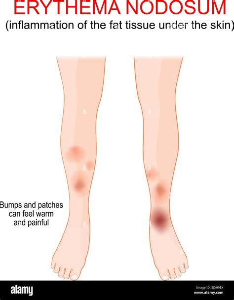 Erythema skin Stock Vector Images - Alamy