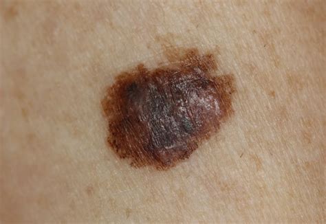 Skin Cancer: Signs, Symptoms, and Complications