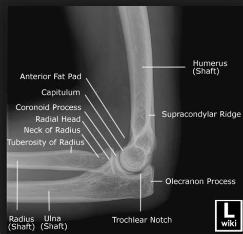 Dislocation of elbow,What to know?