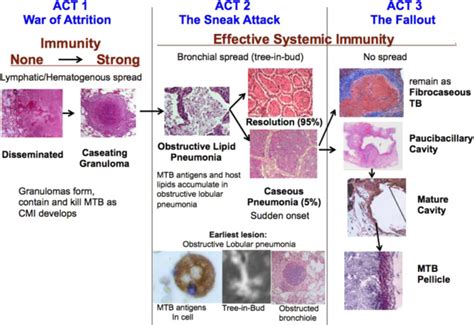 Stages Of Tuberculosis