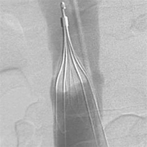 Complications Related to IVC Filter Placement | Download Table