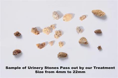 Urinary Stone - drshah