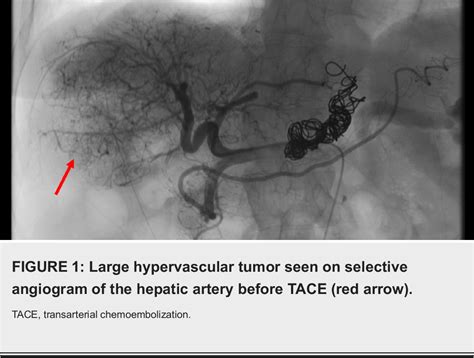 Figure 1 from Post-transarterial Chemoembolization Tumor Rupture in a Patient with Autoimmune ...