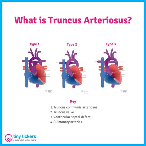 Truncus Arteriosus - Tiny Tickers