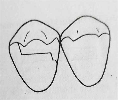 Are Marginal Ridges Marginalised In Your Restorations?