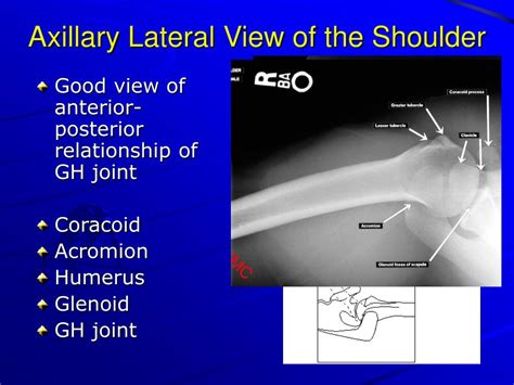 PPT - X-Ray Rounds: (Plain) Radiographic Evaluation of the Shoulder ...