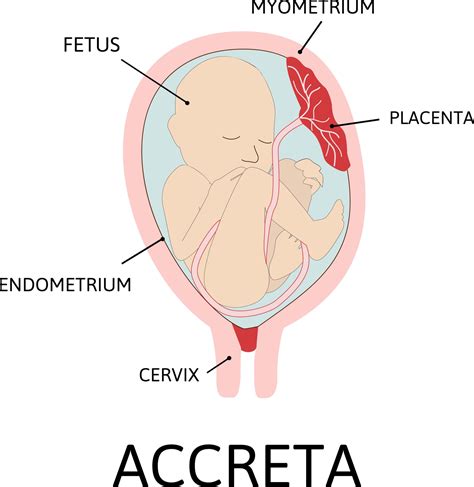 Placenta Accreta - Symptoms, Causes, Complications and Treatment