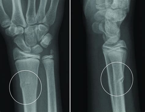 Buckle Fracture Proximal Humerus