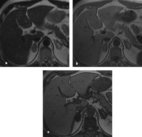 Lipid rich adenoma: 45-year-old female patient with history of uterine ...