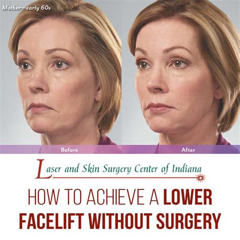 Achieve a Lower Facelift Without Surgery - The Laser and Skin Surgery ...