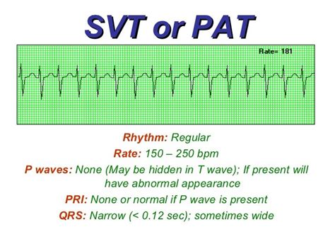 Atrial Rhythms - BMH/Tele