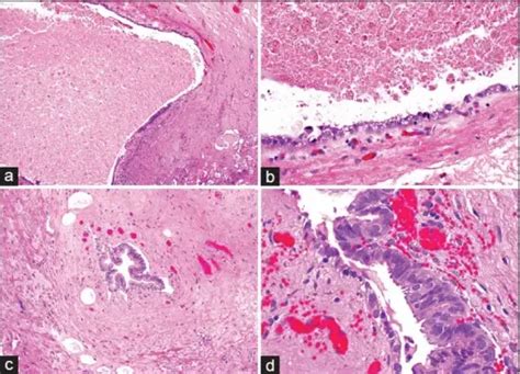 What is Cystitis Cystica? – Pathosomes