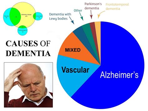 Dementia caused by Parkinson's disease - Alzheimer’s disease: Causes ...