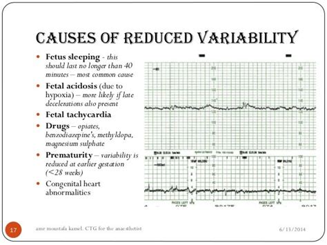 CTG for the anaesthetist