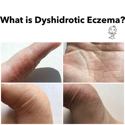 Dyshidrotic Eczema Affect Nails - Nail Ftempo