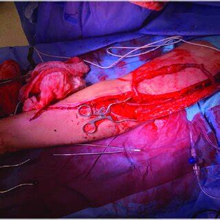 Preoperative fistulogram of radiocephalic fistula showing ulnar artery... | Download Scientific ...