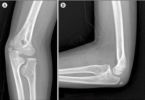 Radial Tuberosity : Its surface is divided into a posterior, rough ...