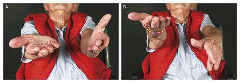 Pronator Drift | NEJM