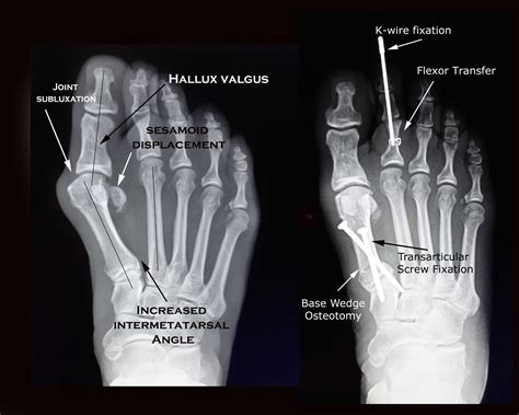 Bunion Surgery Xray