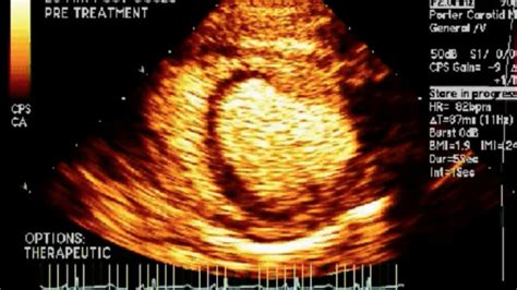 Microvascular Disease: Detection and Treatment Strategies - BroadcastMed