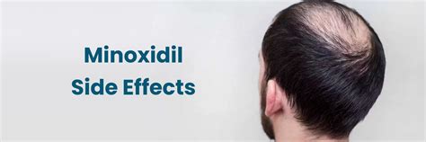 Minoxidil:Side Effects and serious Side Effects