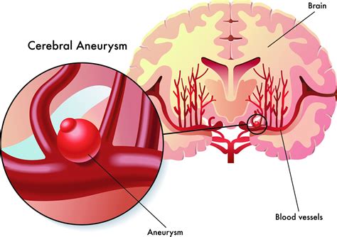 Brain (Cerebral) Aneurysm: Causes, Symptoms and Treatment