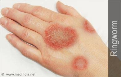 Ringworm | Tinea | Dermatophytosis: Causes Symptoms Signs Treatment FAQ