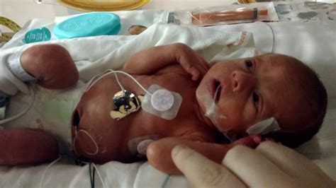 Micro Preemie-born at 31 weeks - YouTube