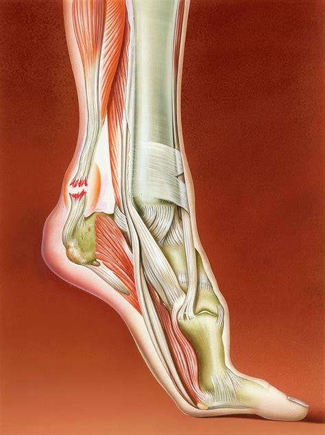 Achilles Tendon Rupture Photograph by John Bavosi - Pixels