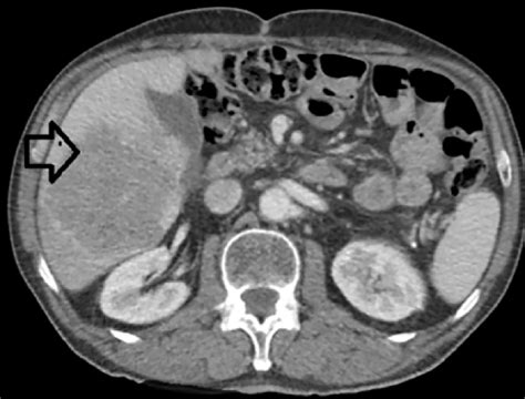 Cureus | Resection of Large Metachronous Liver Metastasis with Gastric Origin: Case Report and ...