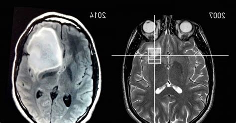 Astrocytoma: types, symptoms, causes and treatment