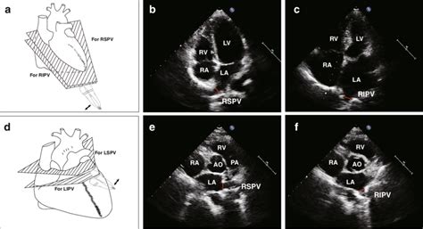 Transthoracic echocardiographic views (a and d) to detect and measure... | Download Scientific ...