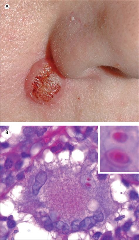 Cutaneous histoplasmosis - The Lancet Infectious Diseases