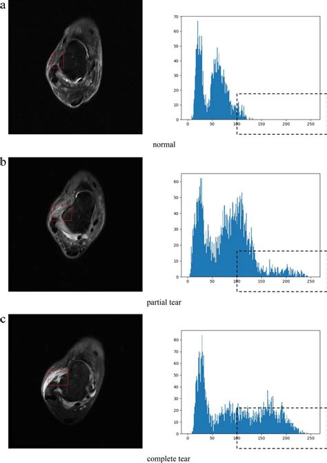 The gray histograms of the ATFL area for normal, partial tear and ...