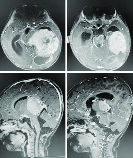 MRI brain showing a largesized lesion in the left lateral ventricle ...