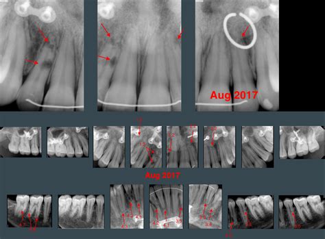 Multiple External Apical Root Resorption – TDO University