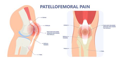 Patellofemoral Pain - Mark Jackson