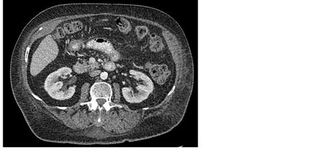 Computed tomography image of the abdomen with oral and intravenous... | Download Scientific Diagram