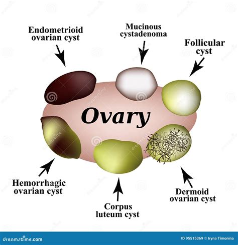 Types Of Ovarian Cysts. Set. Infographics. Vector Illustration On ...