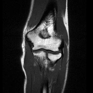 Basic-elbow-mri