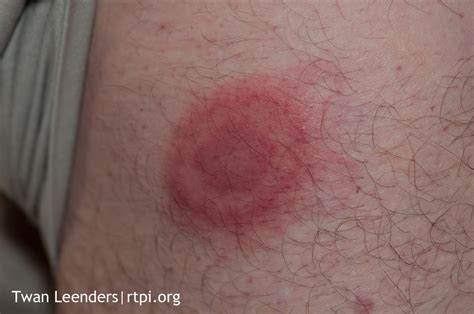 lyme bullseye rash pictures - pictures, photos