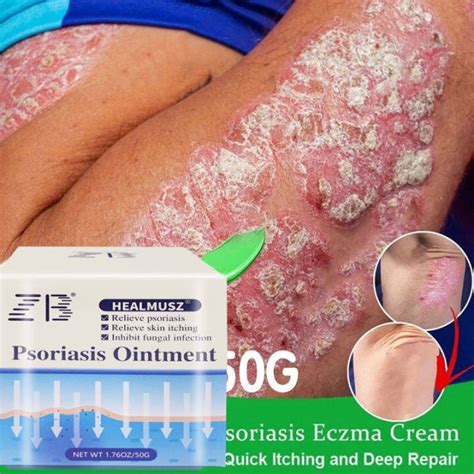 ZB Bacteriostatic Cream 50g Relieve Itching Cream Treating Recurring Eczema Ointment Rashes ...