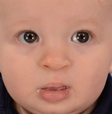 Cleft Lip and Palate Repair Before and After Photos by Christopher ...