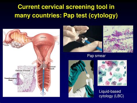 PPT - From cytology to full molecular cervical screening PowerPoint ...