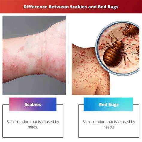 Bed Bug Vs Scabies Rashes Know The Differences – Themelower