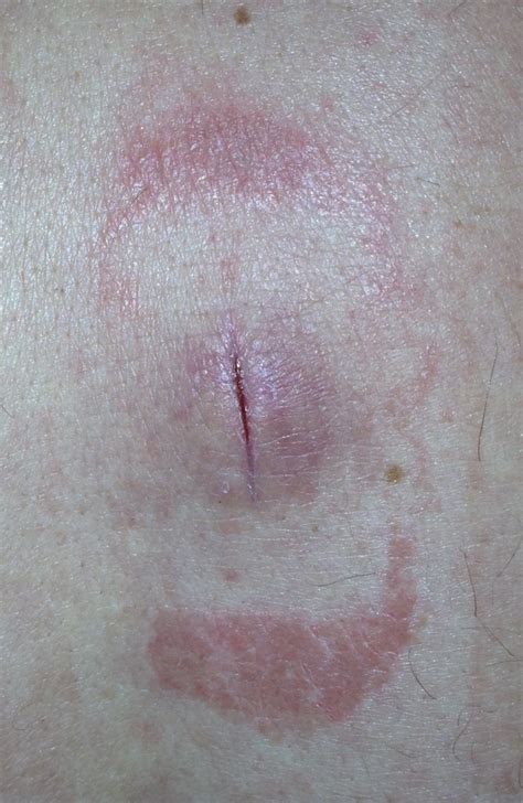 Abscess Incision and Drainage, a Photographic Tutorial | Jail Medicine