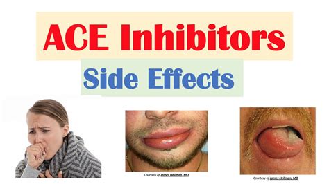 ACE Inhibitor Side Effects: Lisinopril, Ramipril, Captopril ...