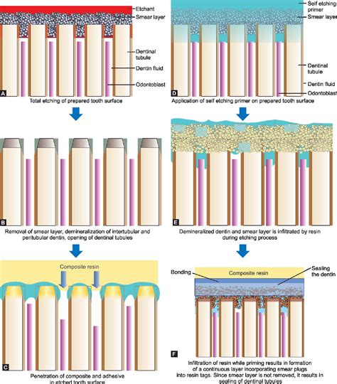 [PDF] Bonding to enamel and dentin | Semantic Scholar