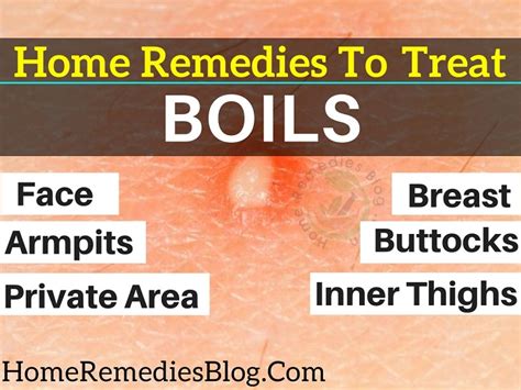 Home Remedies for Boils: 11 Ways to Treat Boils Naturally - Home ...