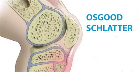 Osgood Schlatter Surgery - Everything You Need To Know - Learning Physio